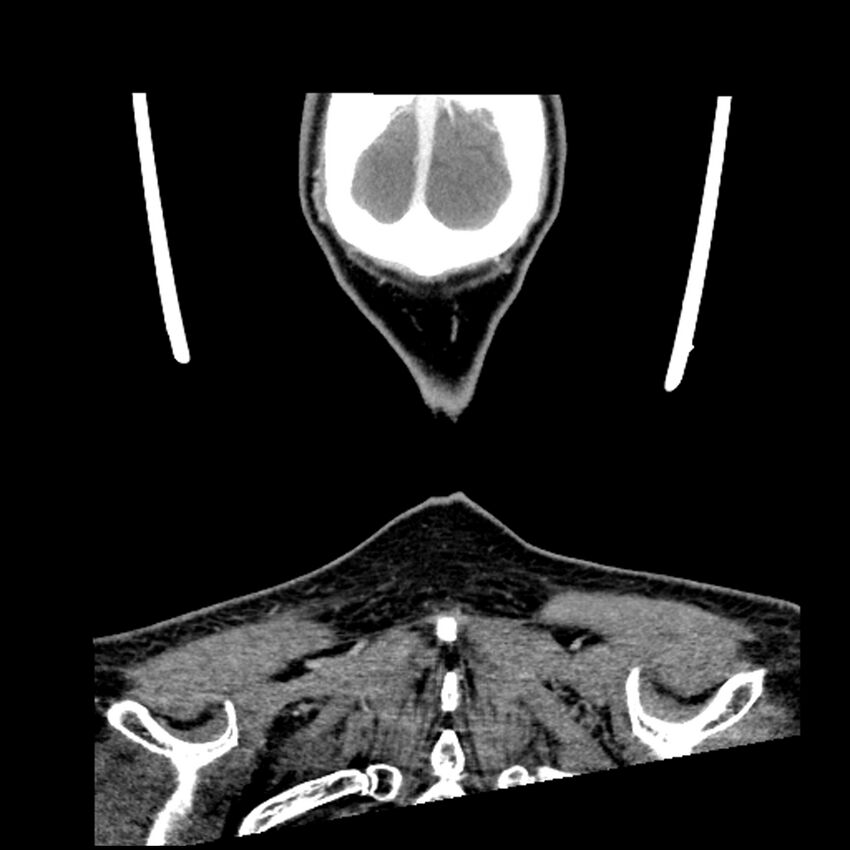 Anaplastic thyroid carcinoma (Radiopaedia 79087-92034 A 111).jpg