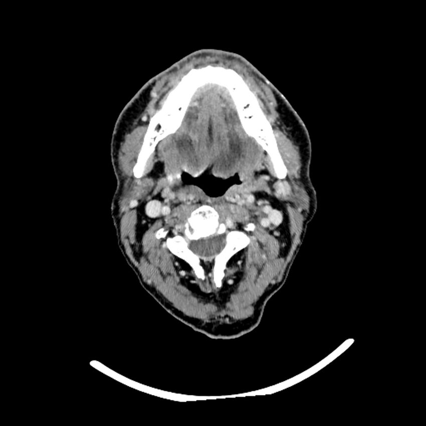 Anaplastic thyroid carcinoma (Radiopaedia 79087-92034 B 88).jpg
