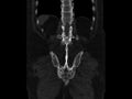 Ankylosing spondylitis (Radiopaedia 44609-48357 Coronal bone window 84).jpg