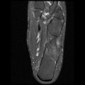 Anterior calcaneal process fracture (Radiopaedia 74654-85611 Axial PD fat sat 22).jpg