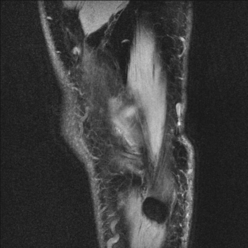 Anterior cruciate ligament mucoid degeneration (Radiopaedia 68400-77933 Sagittal 1).jpg