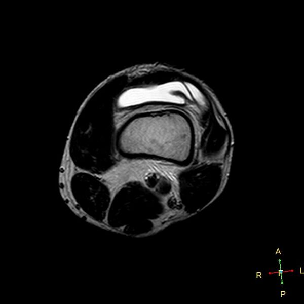 File:Anterior cruciate ligament tear - complete (Radiopaedia 24907-25170 T2 18).jpg