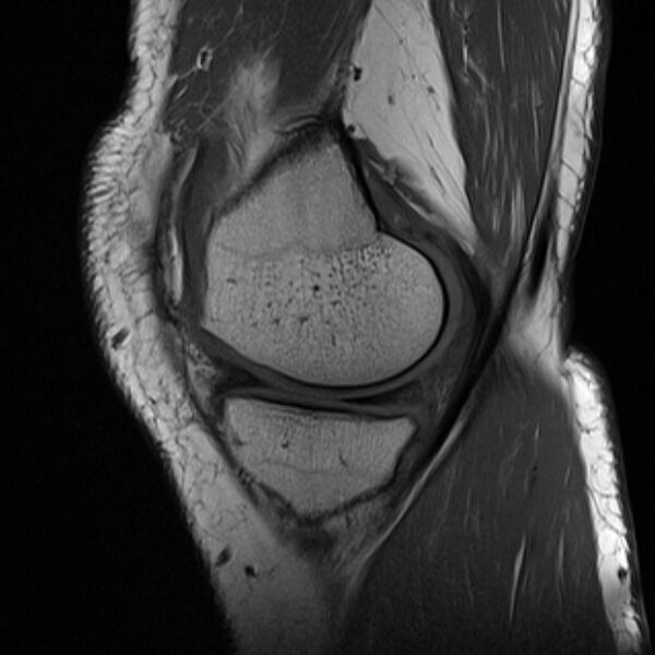 File:Anterior cruciate ligament tear - ramp lesion (Radiopaedia 71883-82322 Sagittal T1 19).jpg