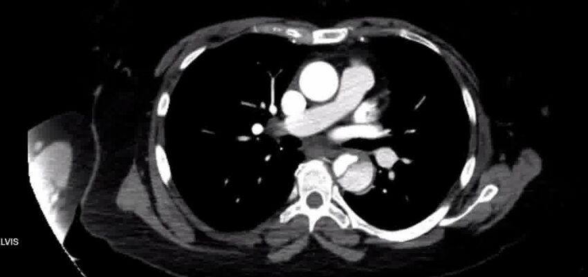 Aortic Dissection (Radiopaedia 85272-100847 A 22).jpg