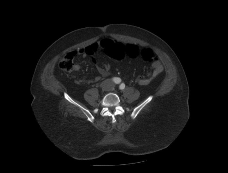 File:Aortic dissection (Radiopaedia 28802-29105 A 78).jpg