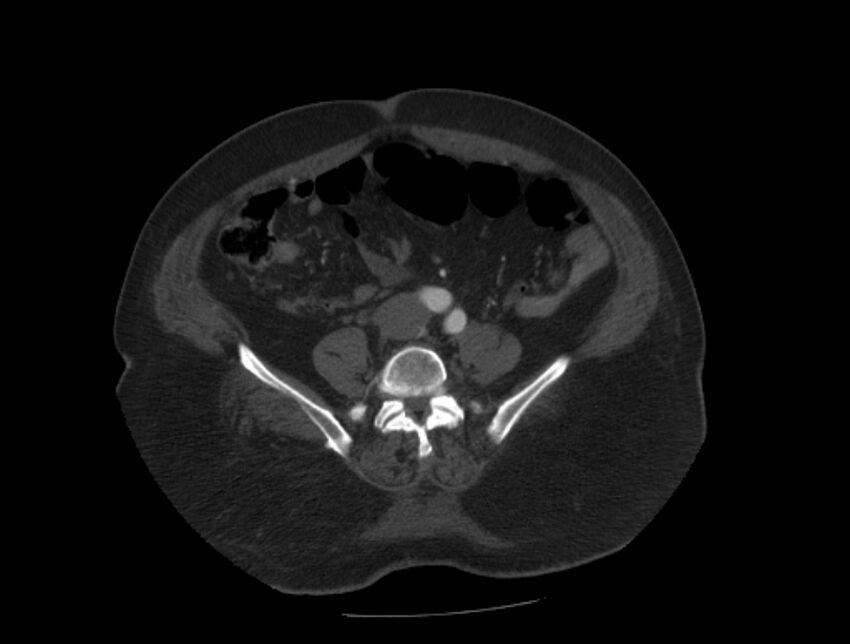 Aortic dissection (Radiopaedia 28802-29105 A 78).jpg