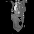 Aortic dissection (Radiopaedia 68763-78691 B 5).jpeg