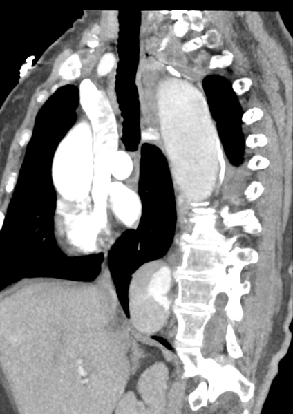 File:Aortic dissection - Stanford type B (Radiopaedia 50171-55512 C 36).png