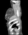 Aortic valve non-coronary cusp thrombus (Radiopaedia 55661-62189 D 4).png