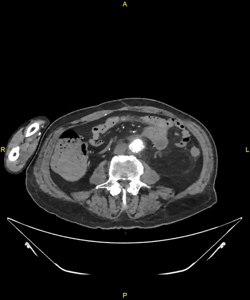 File:Aortoenteric fistula (Radiopaedia 84308-99603 B 212).jpg