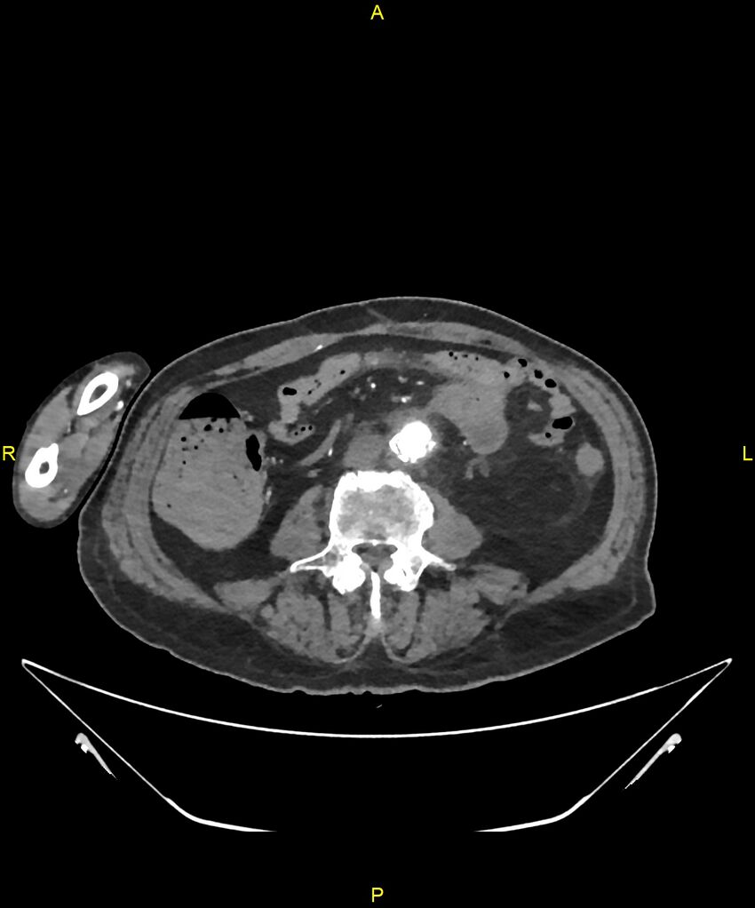 Aortoenteric fistula (Radiopaedia 84308-99603 B 212).jpg