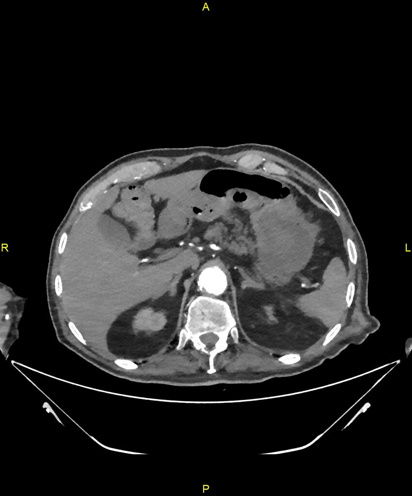 Aortoenteric fistula (Radiopaedia 84308-99603 B 67).jpg