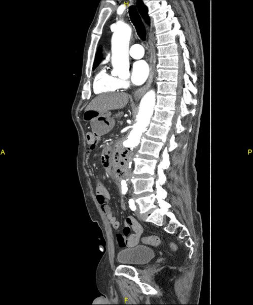 File:Aortoenteric fistula (Radiopaedia 84308-99603 C 183).jpg