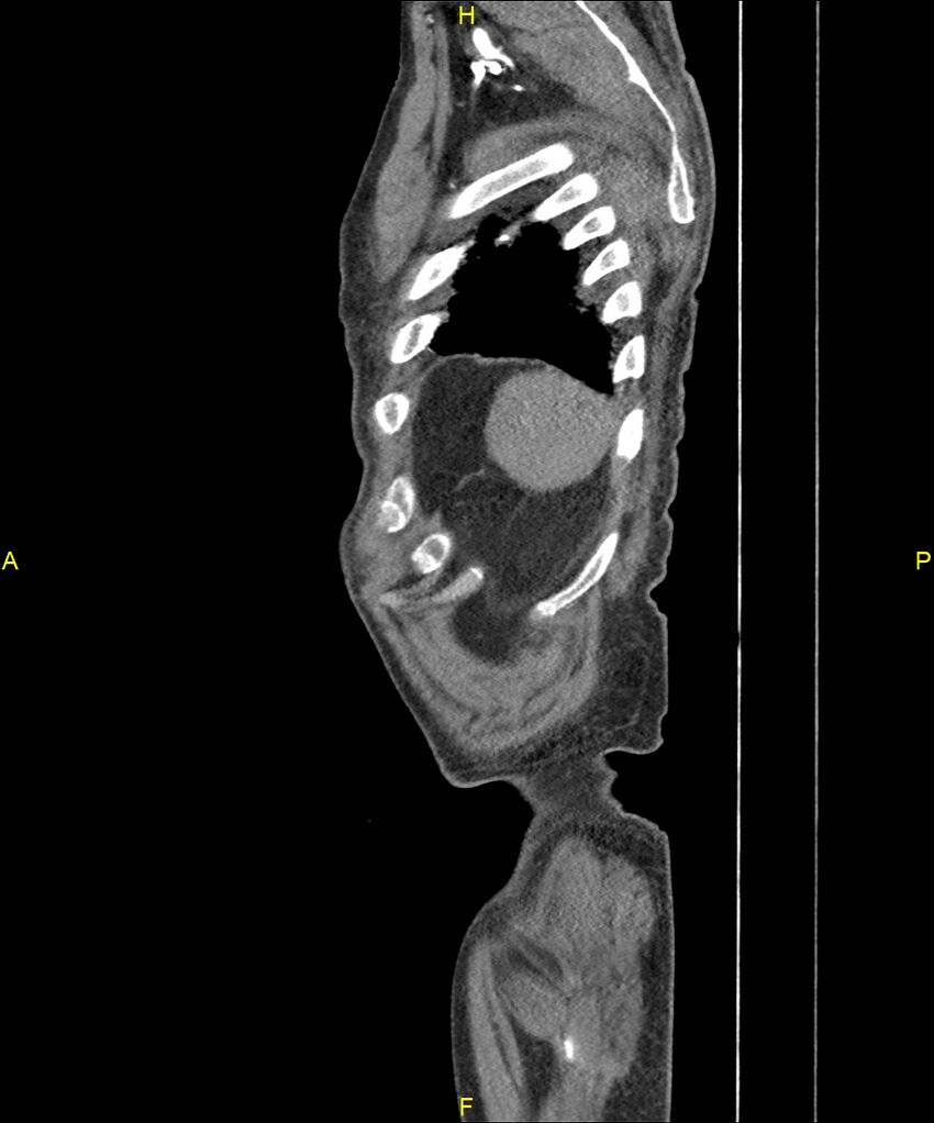 Aortoenteric fistula (Radiopaedia 84308-99603 C 313).jpg