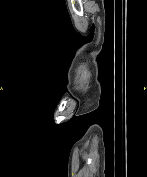 File:Aortoenteric fistula (Radiopaedia 84308-99603 C 9).jpg
