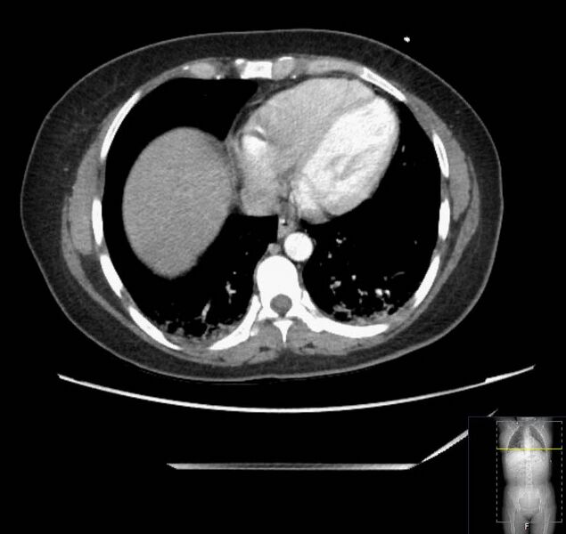 File:Appendicitis (CT angiogram) (Radiopaedia 154713-127660 Axial 181).jpg