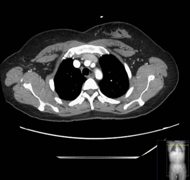 File:Appendicitis (CT angiogram) (Radiopaedia 154713-127660 Axial 225).jpg