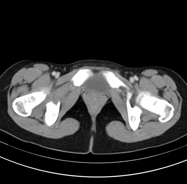 File:Appendicitis and incidental bicornuate uterus (Radiopaedia 22833-22853 B 47).jpg