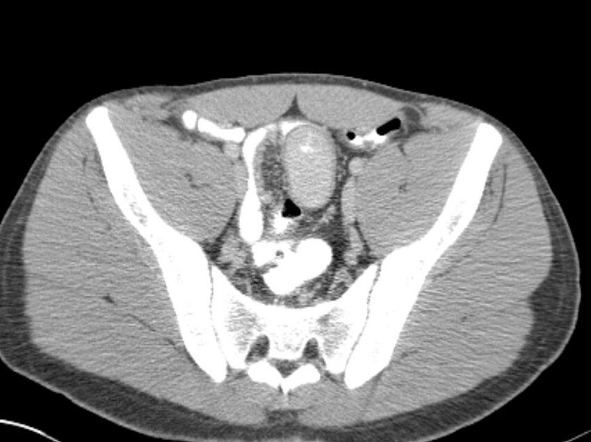 Appendicitis and incidental foregut duplication cyst (Radiopaedia 52962-58916 A 78).jpg