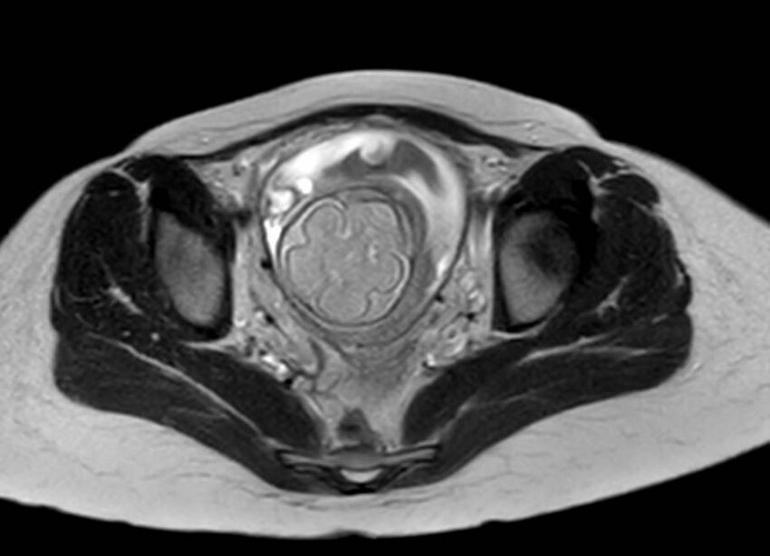Appendicitis in gravida (MRI) (Radiopaedia 89433-106395 Axial T2 61).jpg