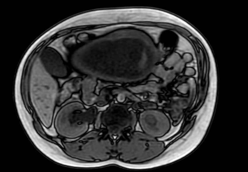 Appendicitis in gravida (MRI) (Radiopaedia 89433-106395 D 26).jpg