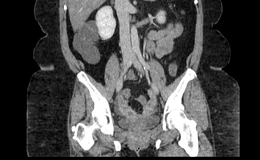 Appendix mucocele (Radiopaedia 41222-44033 B 48).jpg