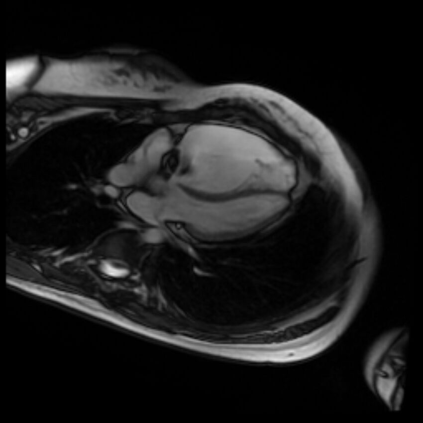 Arrhythmogenic right ventricular cardiomyopathy (Radiopaedia 87505-103850 4ch Cine SSFP 54).jpg