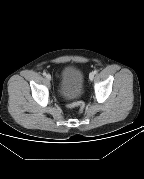 File:Arterial occlusive mesenteric ischemia (Radiopaedia 84641-100054 A 106).jpg