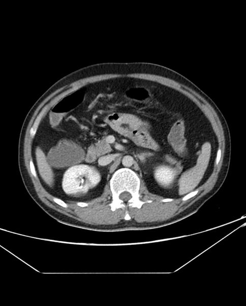 File:Arterial occlusive mesenteric ischemia (Radiopaedia 84641-100054 A 43).jpg