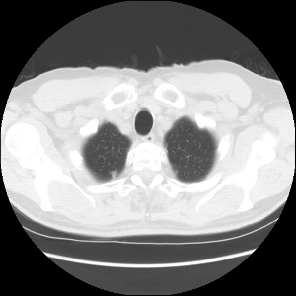 File:Asbestos-related pleural plaques (Radiopaedia 39069-41255 Axial lung window 7).jpg