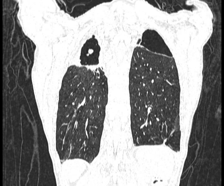 File:Aspergillomas (Radiopaedia 66779-76110 Coronal lung window 17).jpg