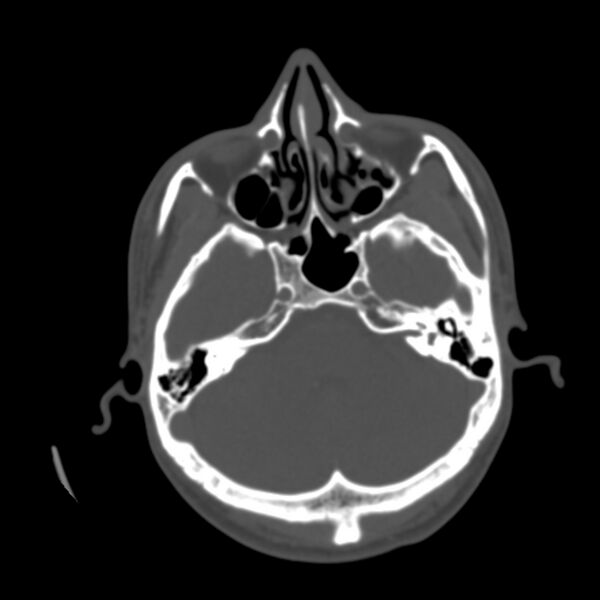 File:Asymptomatic occipital spur (Radiopaedia 87753-104201 Axial bone window 40).jpg