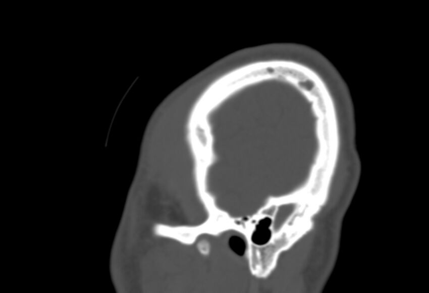 Asymptomatic occipital spur (Radiopaedia 87753-104201 Sagittal bone window 293).jpg