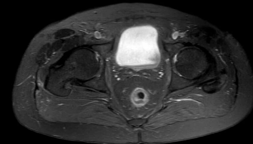 Atypical lipomatous tumor - thigh (Radiopaedia 68975-78734 Axial PD fat sat 93).jpg
