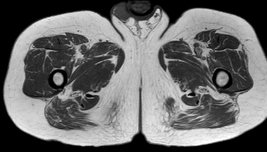 Atypical lipomatous tumor - thigh (Radiopaedia 68975-78734 Axial T1 74).jpg
