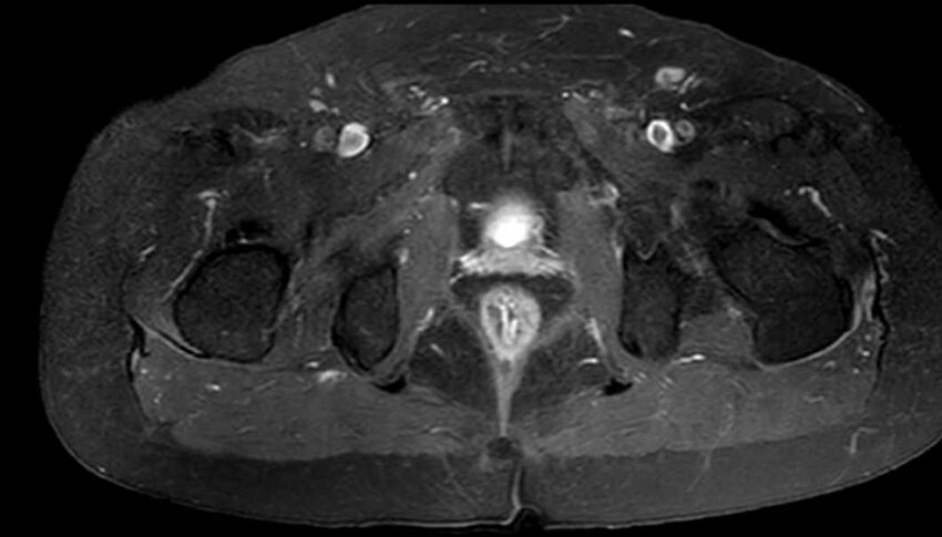 Atypical lipomatous tumor - thigh (Radiopaedia 68975-78734 Axial T1 C+ fat sat 88).jpg
