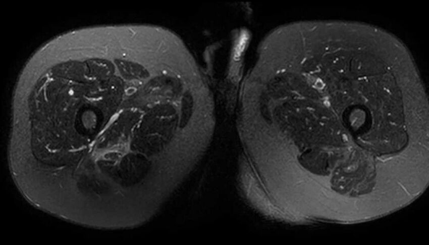Atypical lipomatous tumor - thigh (Radiopaedia 68975-78734 Axial T2 fat sat 67).jpg