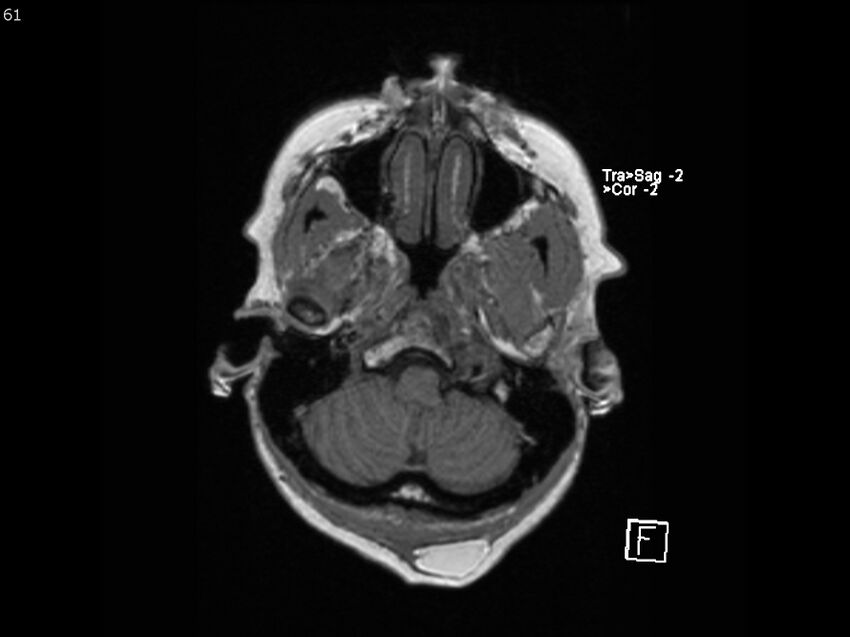 Atypical meningioma - intraosseous (Radiopaedia 64915-74572 Axial T1 61).jpg