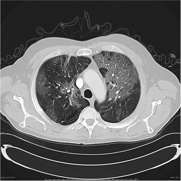 File:Atypical pneumonia - Q fever (Radiopaedia 21993-21989 lung window 10).jpg