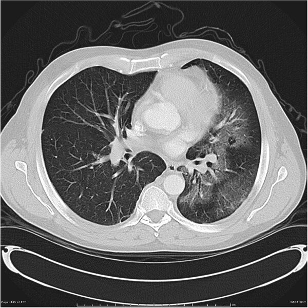 File:Atypical pneumonia - Q fever (Radiopaedia 21993-21989 lung window 24).jpg