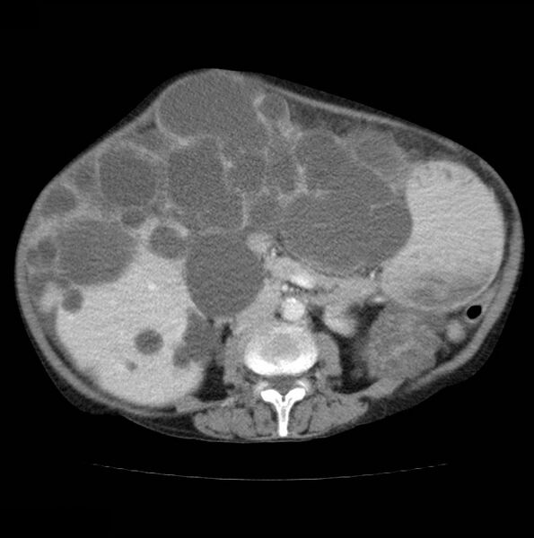 File:Autosomal dominant polycystic kidney disease (Radiopaedia 16777-16490 A 31).jpg
