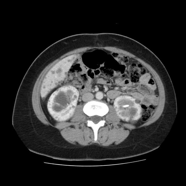 File:Autosomal dominant polycystic kidney disease (Radiopaedia 23061-23093 C 35).jpg