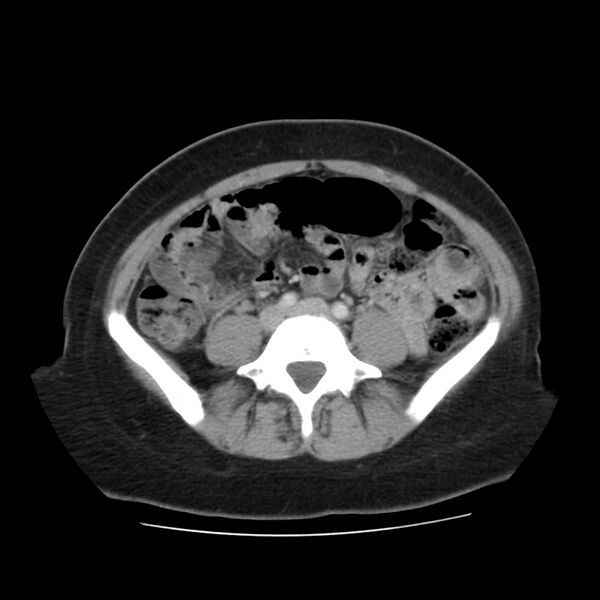 File:Autosomal dominant polycystic kidney disease (Radiopaedia 23061-23093 C 45).jpg
