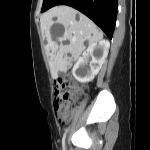 File:Autosomal dominant polycystic kidney disease (Radiopaedia 23061-23093 F 15).jpg