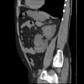Autosomal dominant polycystic kidney disease (Radiopaedia 36539-38101 D 56).jpg