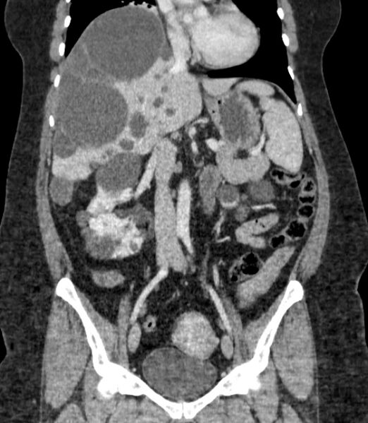 File:Autosomal dominant polycystic kidney disease (Radiopaedia 57124-64017 B 38).jpg