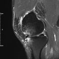 Avulsion fracture of the fibular head (Radiopaedia 74804-85808 Sagittal PD fat sat 12).jpg