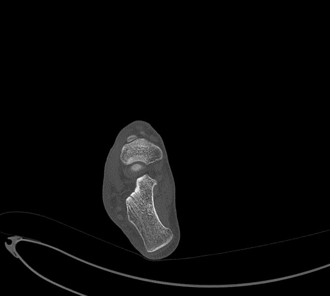 File:Avulsion fractures of talus and calcaneus (Radiopaedia 48277-53155 Axial bone window 60).jpg