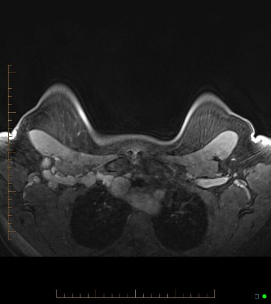 File:Axillary lymphadenopathy on breast MRI- yellow fever vaccination induced (Radiopaedia 19454-19483 Axial T1 C+ fat sat 10).jpg