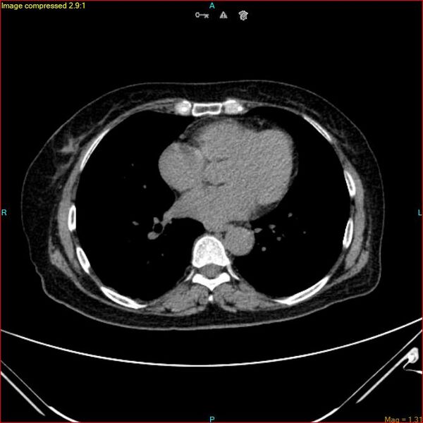 File:Azygos vein aneurysm (Radiopaedia 77824-90130 A 37).jpg